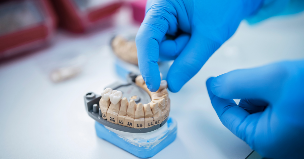How a Cantilever Single Tooth Bridge Can Transform Your Smile