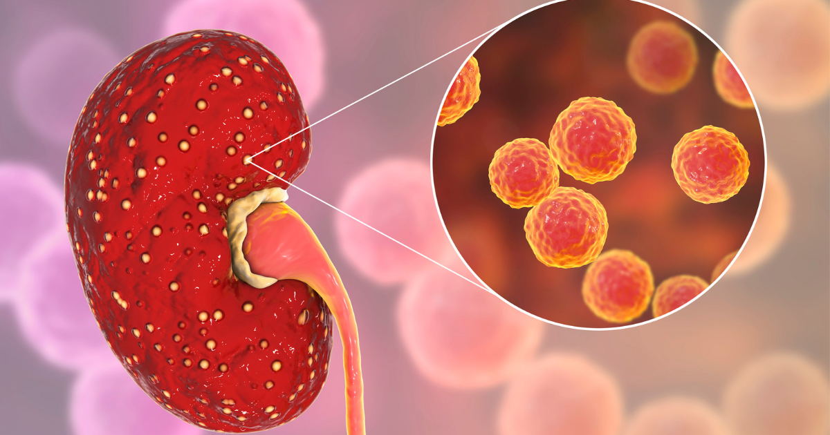 Understanding the Connection: How does a urinary tract infection cause bloating