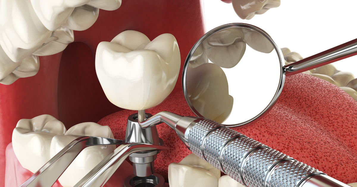 Normal Socket After Tooth Extraction: What It Should Look Like?