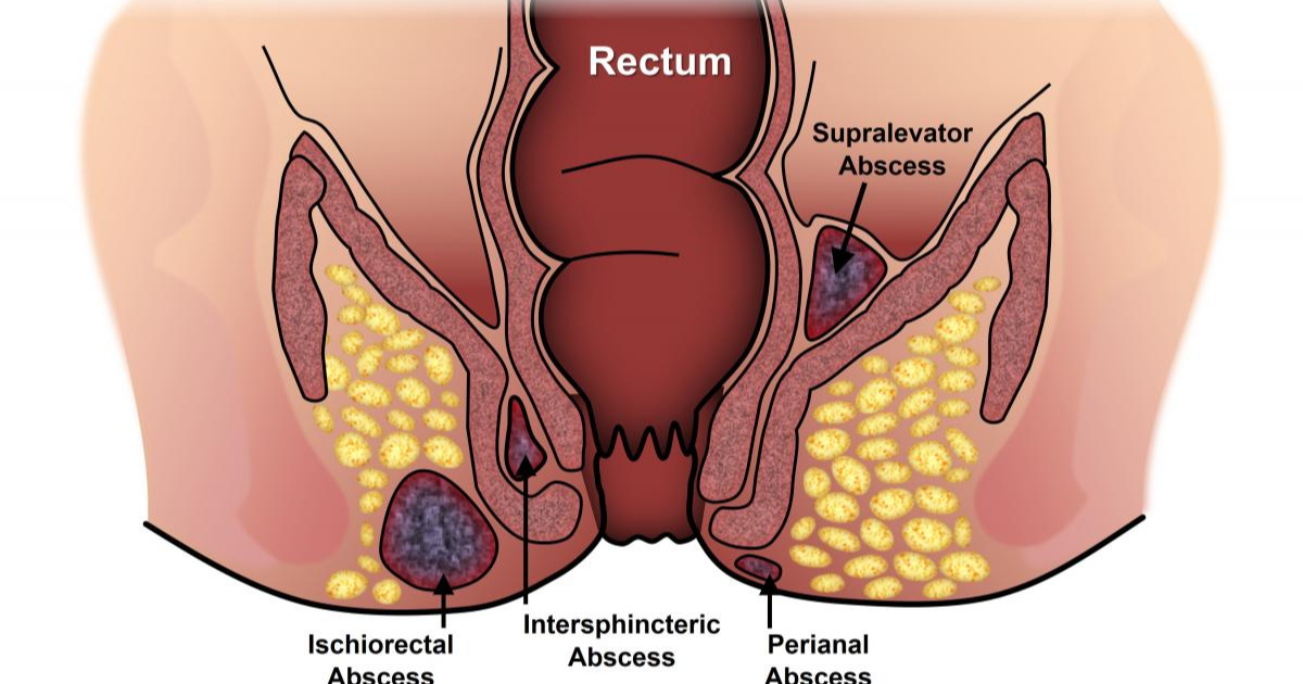 Perianal Hematoma vs. Anal Abscess: Key Differences You Must Know