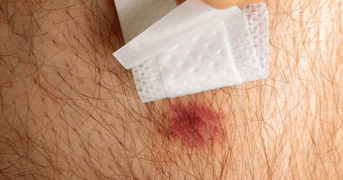 Venomous Spider Bite Pictures: What Happens Without Treatment
